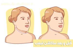 قبل و بعد ساکشن غبغب