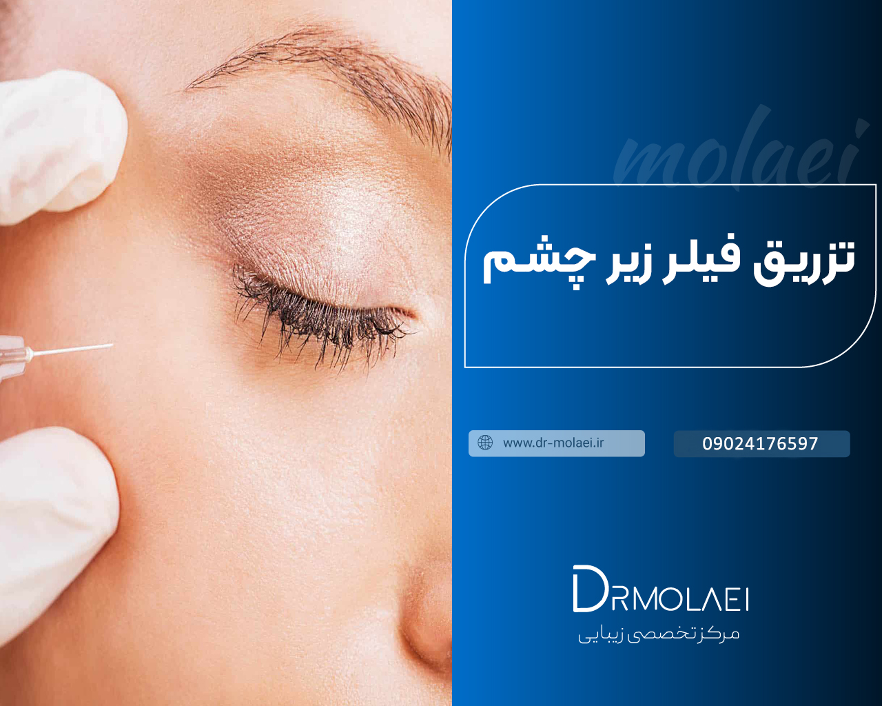 تزریق فیلر زیر چشم
