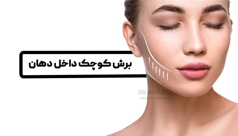 مراحل جراحی بوکال فت