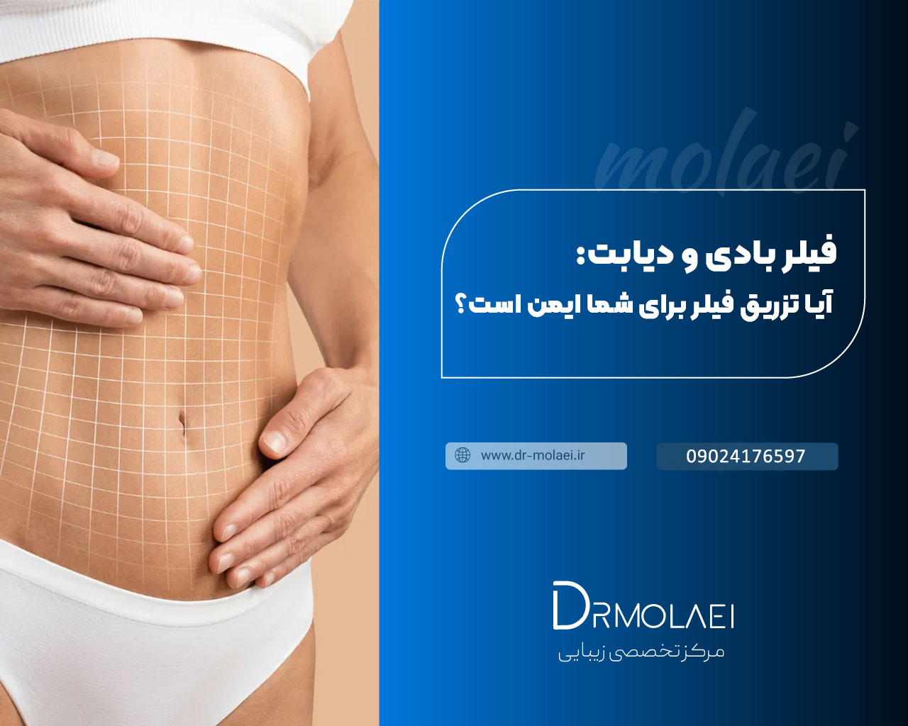 تزریق فیلر بادی برای افراد دیابتی