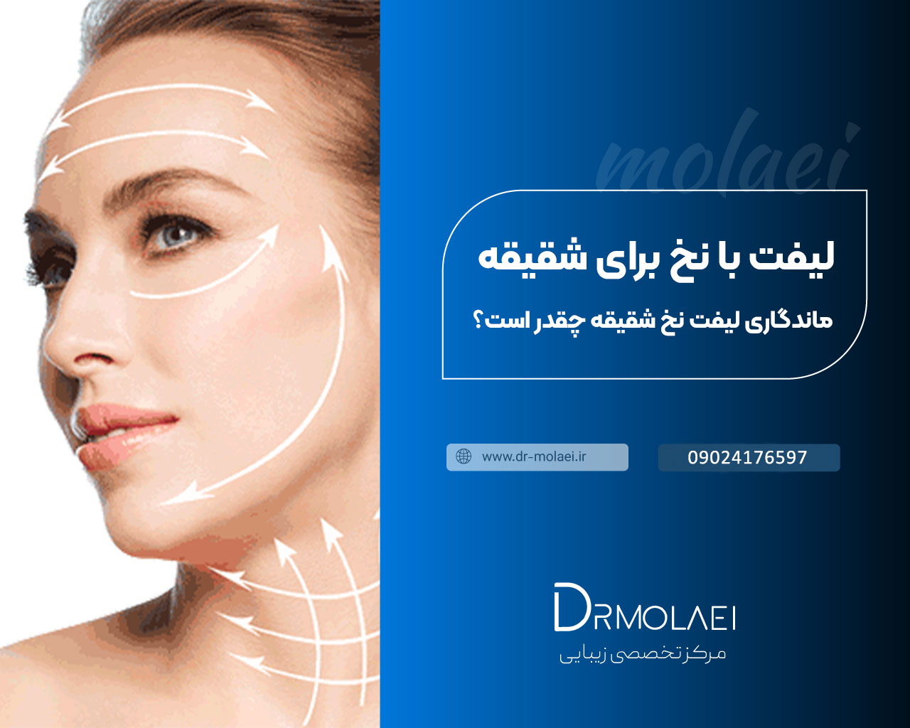 ماندگاری لیفت نخ شقیقه