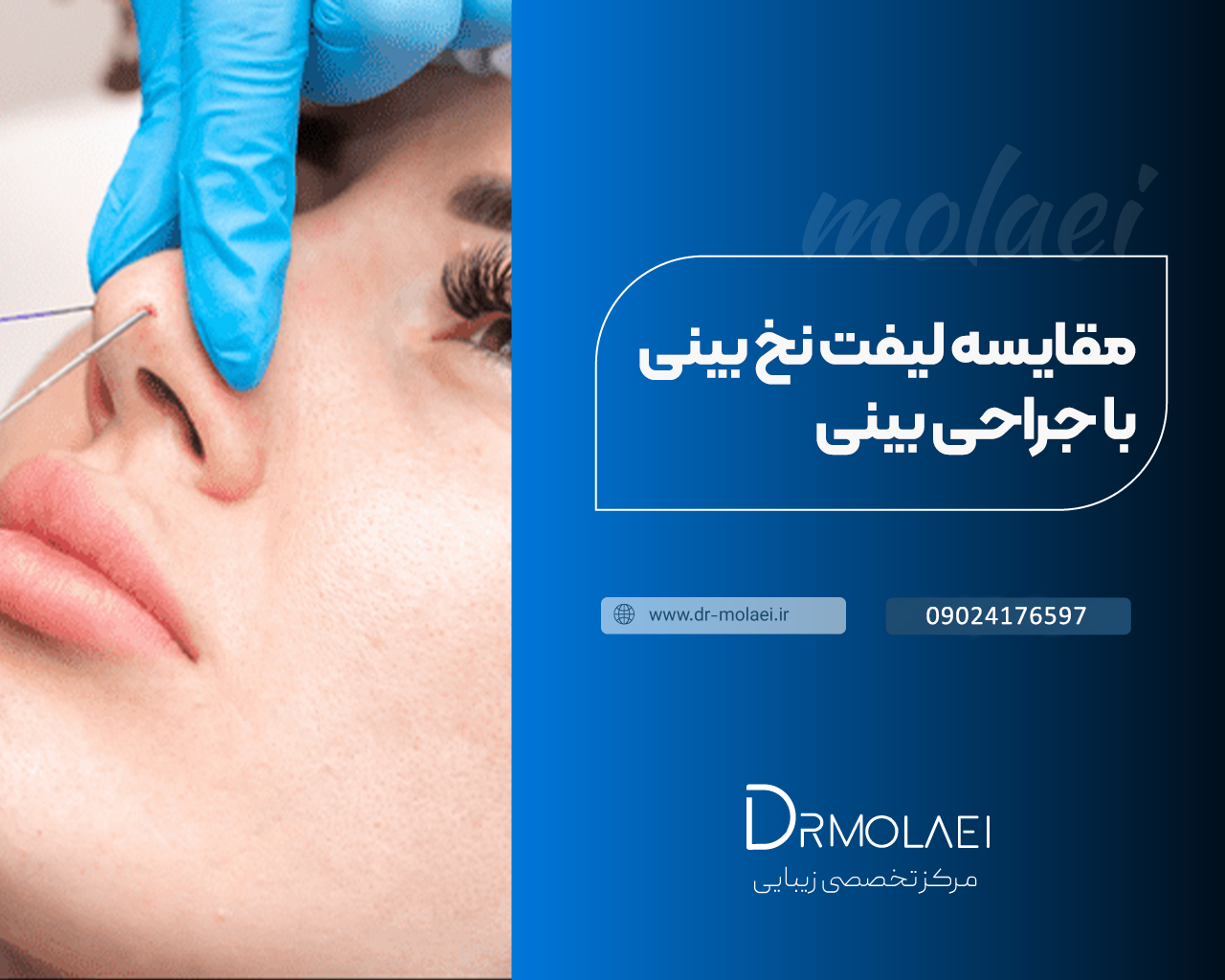 مقایسه لیفت نخ بینی با جراحی بینی