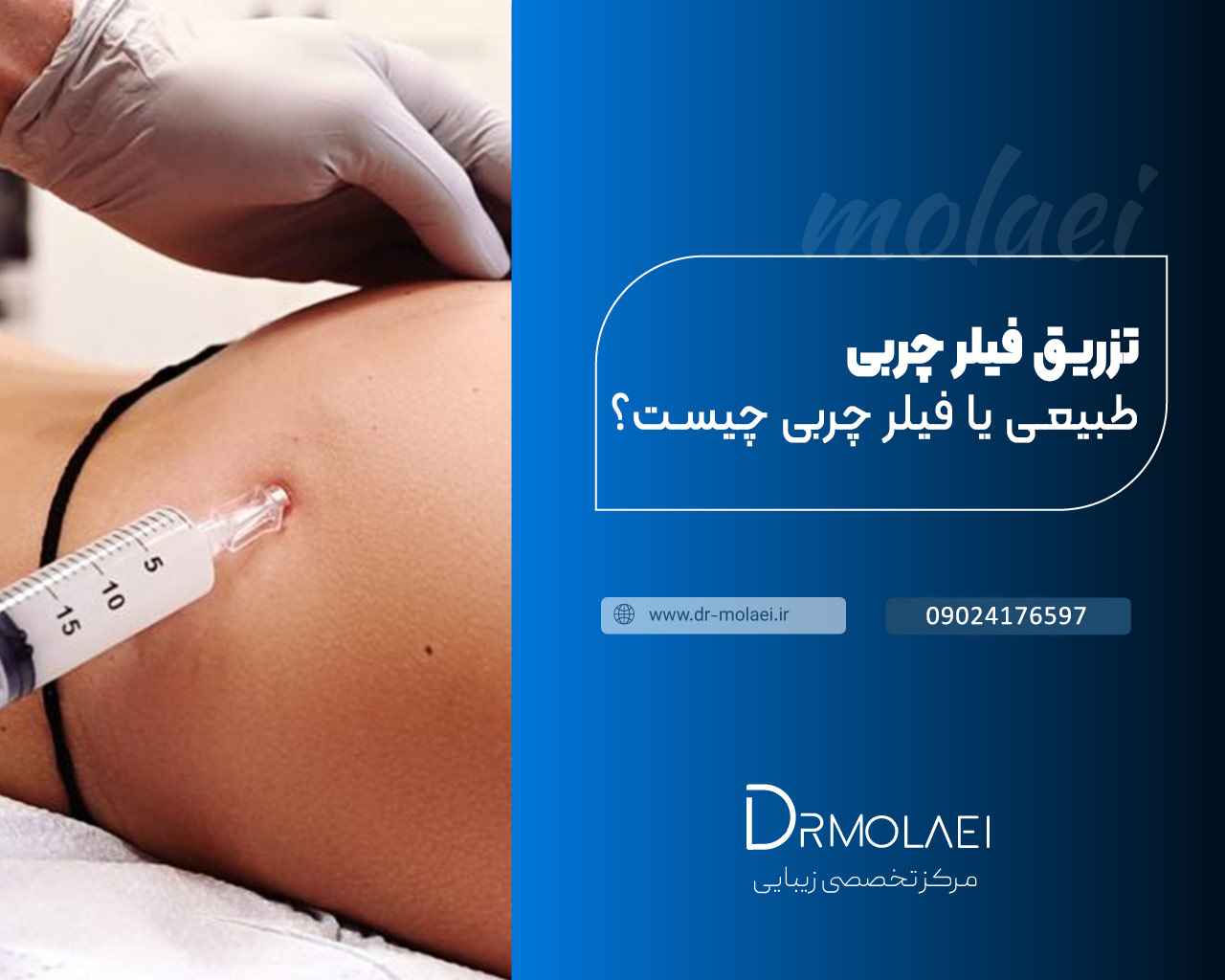 تزریق فیلر چربی
