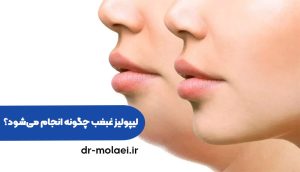 1 2 لیپولیز غبغب چیست
