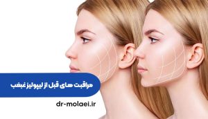 مراقبت های قبل از لیپولیز غبغب