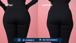5 6 تزریق فیلر در باسن