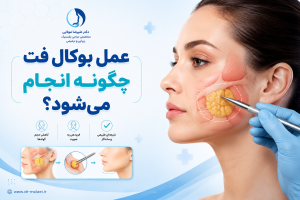 عمل بوکال فت چگونه انجام میشود؟