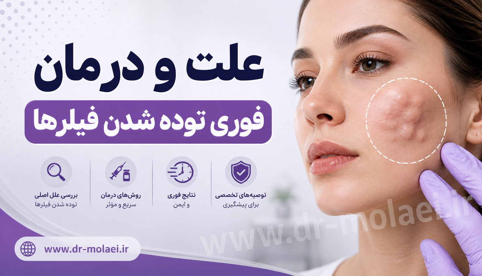 توده شدن فیلر