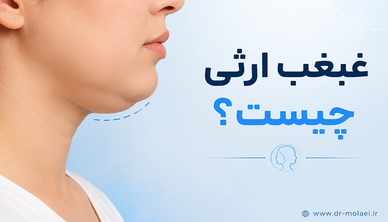 غبغب ارثی