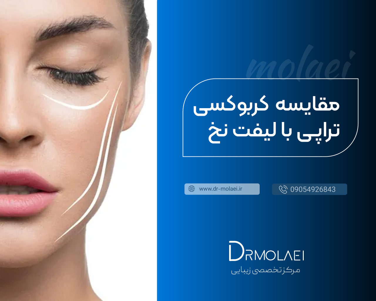 مقایسه کربوکسی تراپی با لیفت نخ