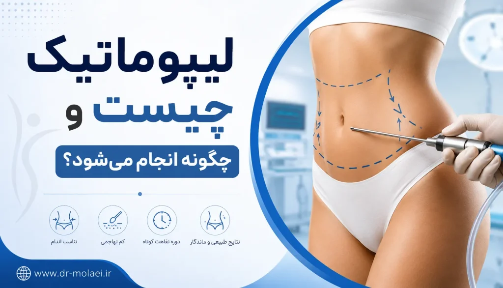 لیپوماتیک چیست