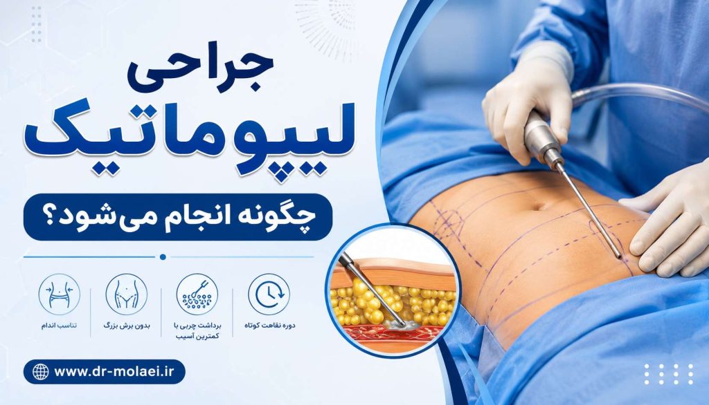 جراحی لیپوماتیک چگونه انجام میشود؟