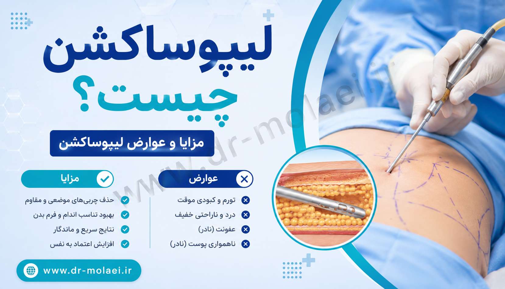 لیپوساکشن چیست