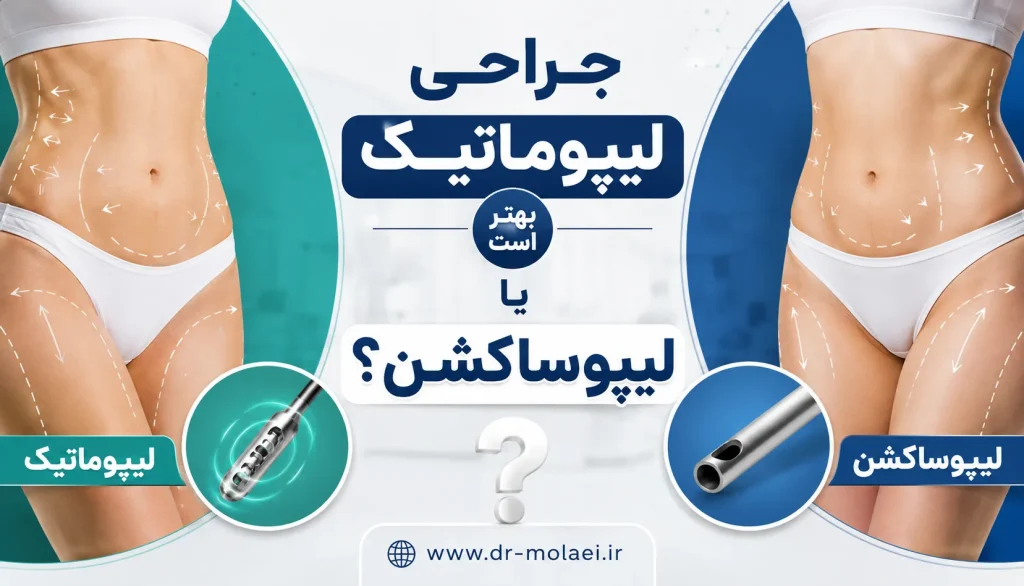 ef3c8228 ee8a 475b 9fc2 04602068b415 optimized تفاوت لیپوماتیک و لیپوساکشن